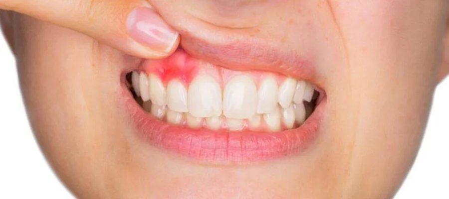 diş eti hastalıkları