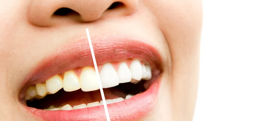 Mecidiyeköy Diş Beyazlatma